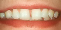 Perfect Smile open diastema